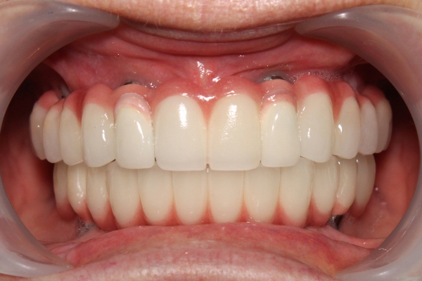 Close up of an actual patients mouth showing dental implants in Poway CA look just like your natural teeth