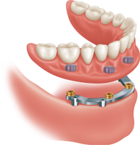 Illustration of a bar over dentures dental implant option and how it is placed. 