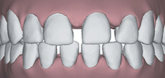 Illustration of gapped teeth to show that Invisalign in Poway, CA can correct this issue.