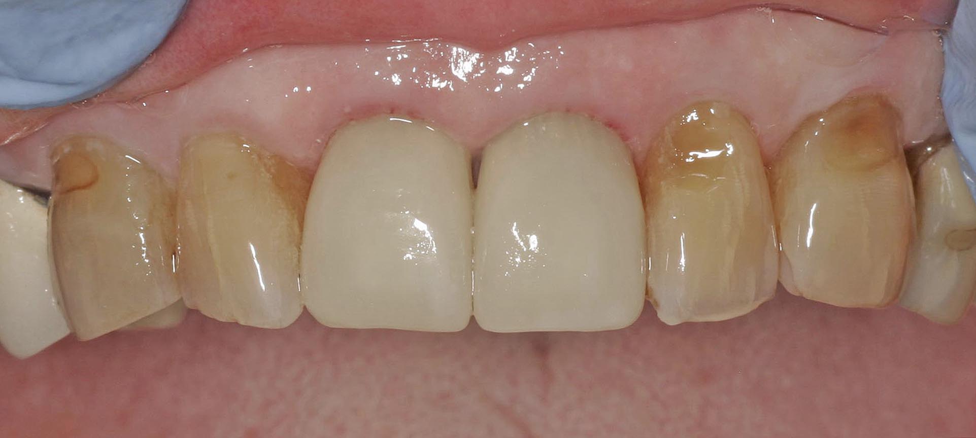 Close up of an actual patient mouth after the dental implant procedure has been completed