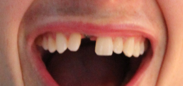 Close up of an actual patients mouth with a missing tooth who is about to receive dental implants to correct the issue