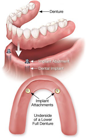 A more detailed illustration of how dental implants over dentures are placed. 