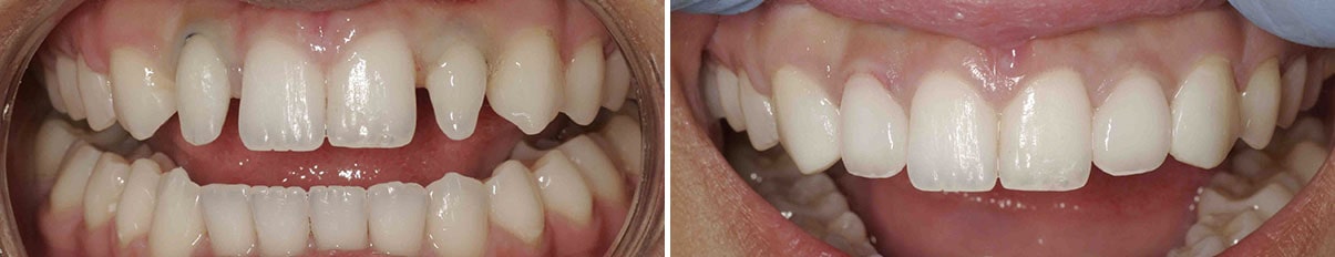 Before and after of a patient's smile with porcelain veneers