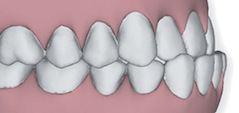 Illustration of teeth with a sever underbite to show that Invisalign in Poway, CA can correct this issue.