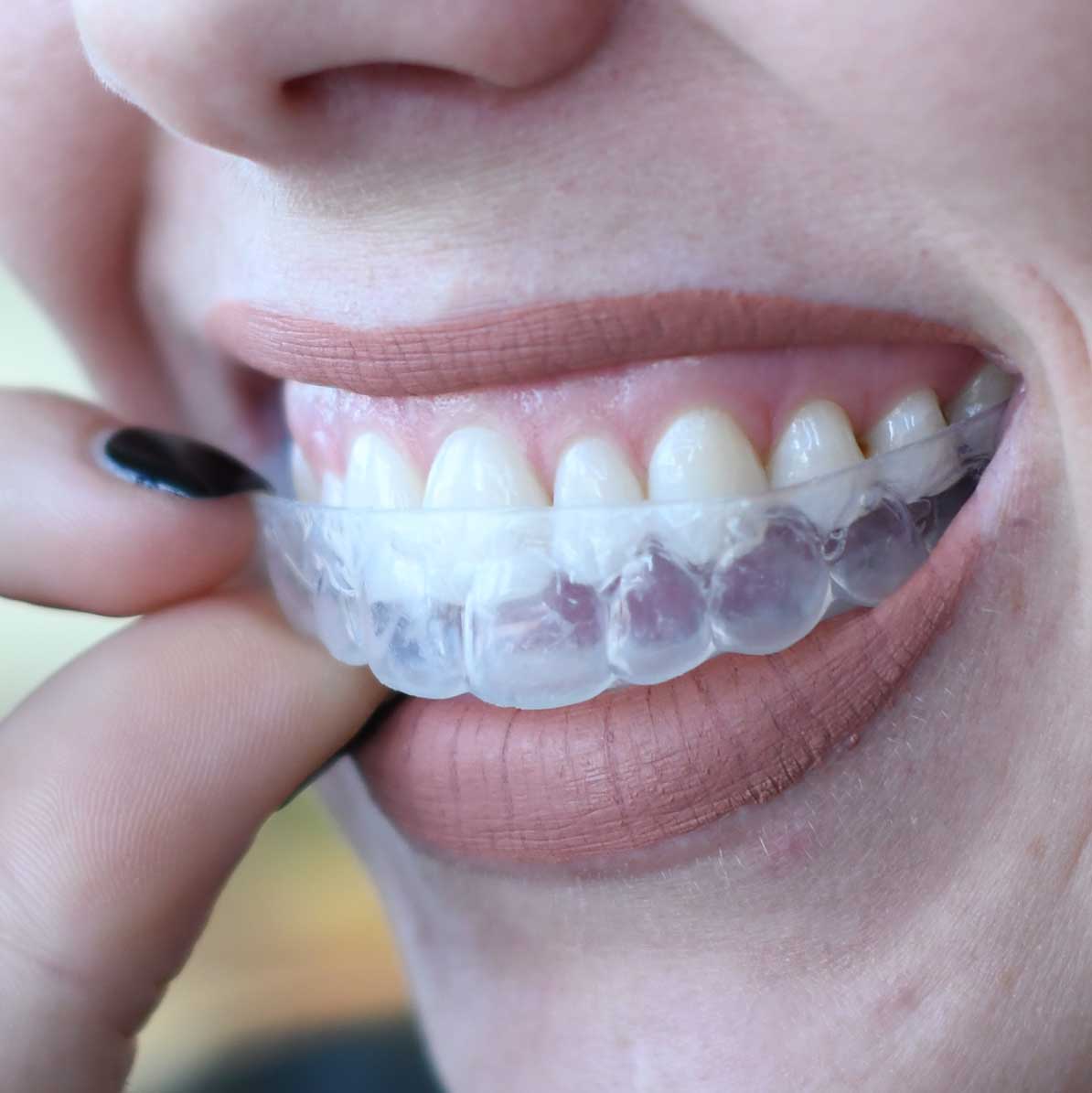 Close up of a woman inserting custom teeth whitening tray in Poway, CA