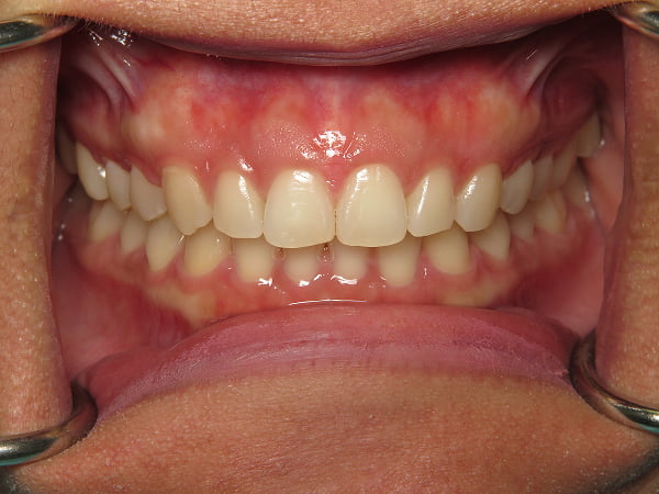 A close-up of a patient's teeth after clear aligner treatment