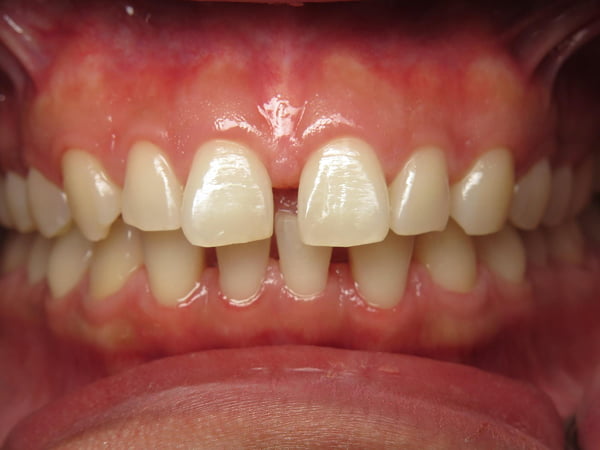 A close-up of a patient's teeth before clear aligner treatment